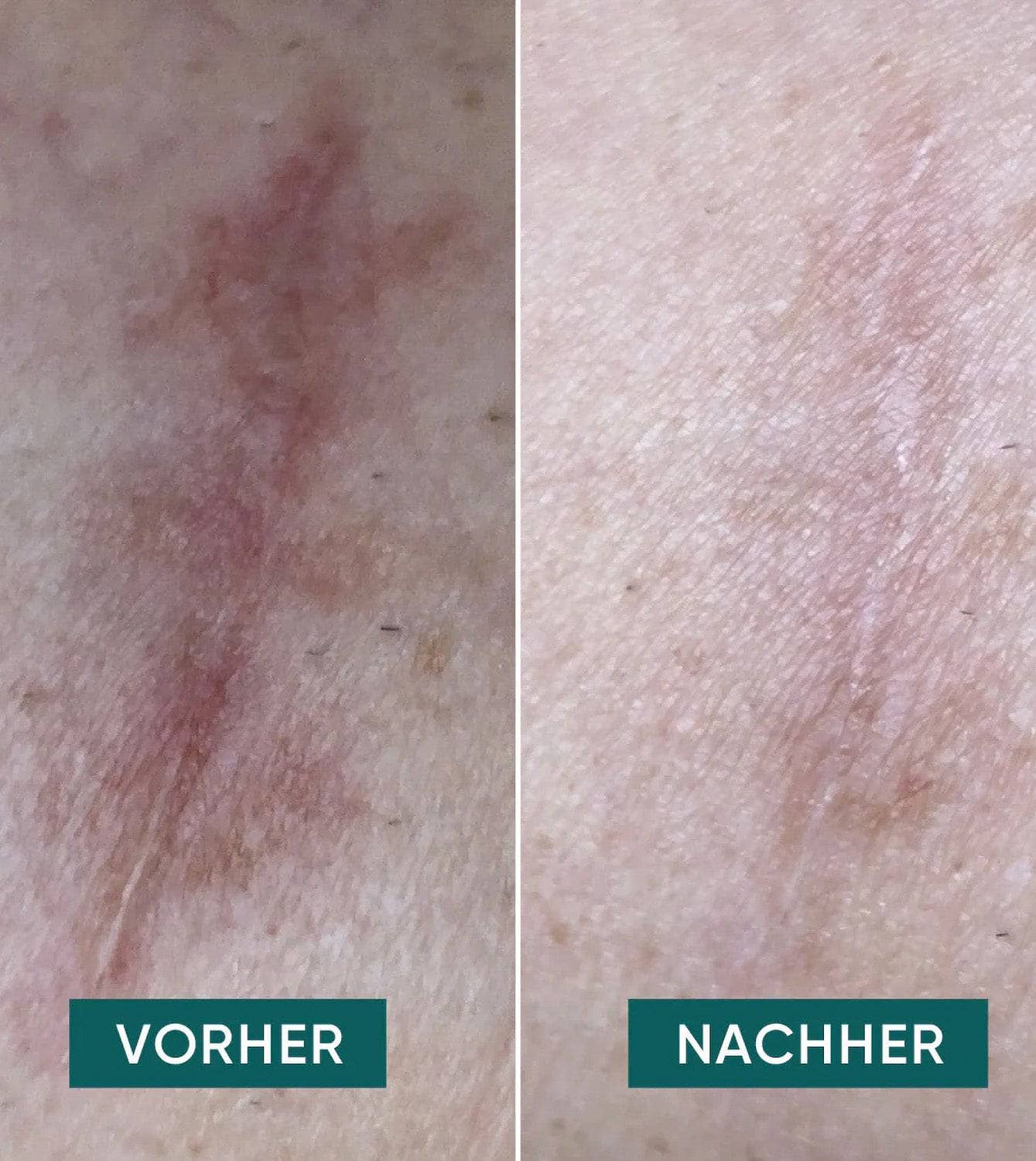 Wiederverwendbare Narben-Pads