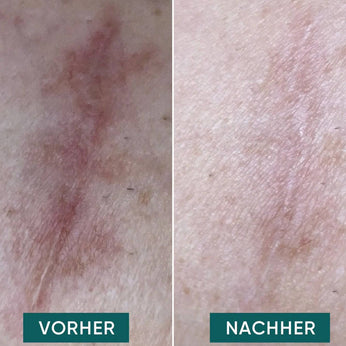 Wiederverwendbare Narben-Pads 
